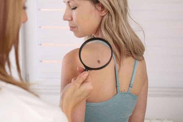 What Are Traditional Skin Lesion Removal Methods Ealing?