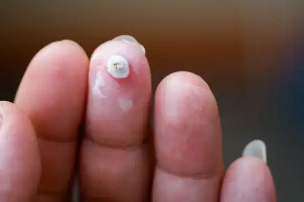 Image of white wart before cryopen treatment Ealing