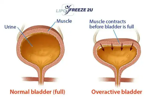 diagram of overactive bladder treatment Ealing