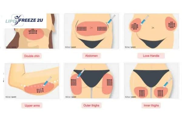 Benefits of Choosing Aqualyx for Fat Reduction Ealing