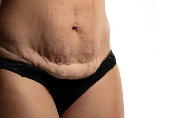 loose skin after weight loss injections Ealing