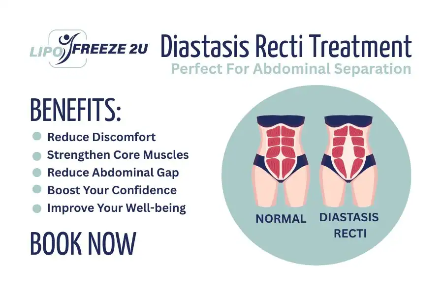 How Long Will It Take to See Improvements in Diastasis Recti Ealing