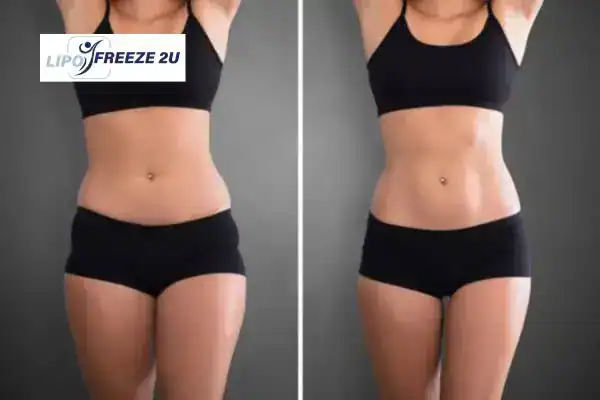 How Can LIPO FREEZE 2U Support Your Post-Pregnancy Body Recovery Ealing?