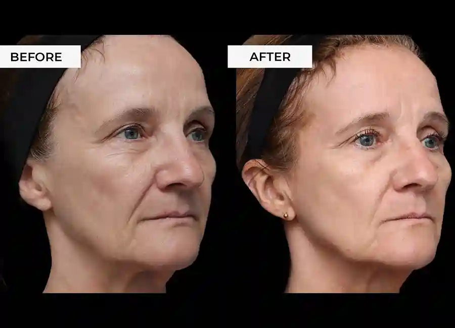 How Many RF Microneedling Sessions Will You Need to See a Difference Ealing?