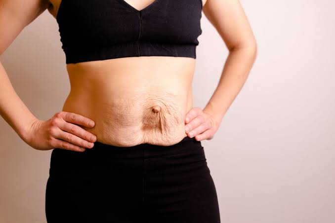 Is Surgery Really the Only Way to Repair Diastasis Recti Ealing?