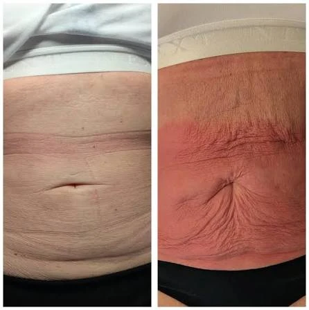 How Does RF Microneedling Improve Crepey, Thin and Uneven Skin Texture Ealing?
