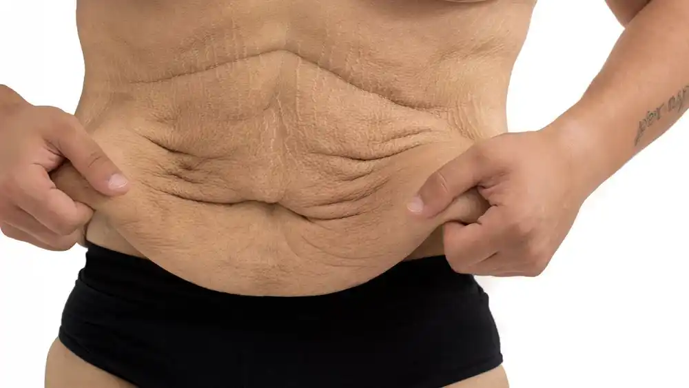 Why Does Weight Loss Medication Leave Some People With Loose or Sagging Skin Ealing?